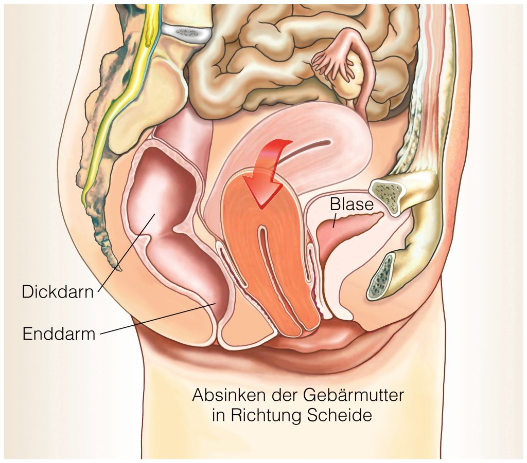 Was passiert bei einer Gebärmuttersenkung